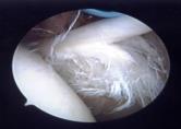 Boileau P, Ahrens PM, Hatzidakis AM Partial tear Uncommon as an isolated lesion Rotator cuff pathology usually