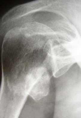 Standards X Rays How to analyse less tuberosity?