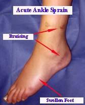 Sprain: Swelling