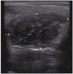 2: Malignant non-homogenous lesion with blurred margins. Fig. 2 Fig.