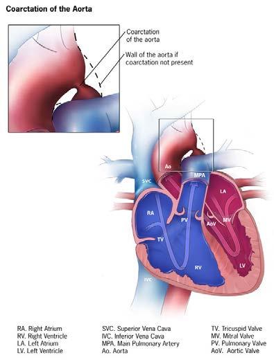 Critical Congenital Heart Disease Affected infants appear well due to the presence of a ductus arteriosus that provides flow and oxygenation to the lungs and/or the body