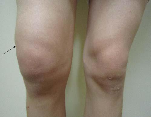 Knee exam case #1: Inspection Significance of acute traumatic effusion Intra articular