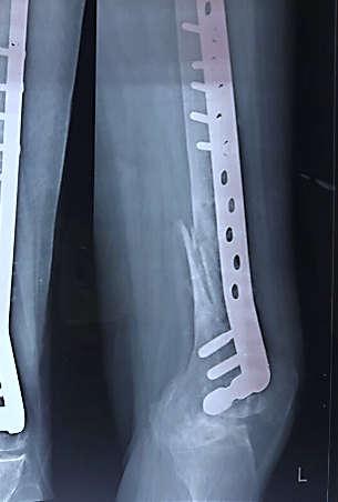 X-ray distal end of left femur antero-posterior view of case