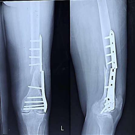 X-ray taken on June 2017 also showing no sign of fracture