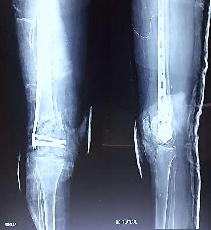 But last x-ray taken in August 2017 showing complete 