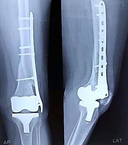 compound fracture of distal femur with intra articular extensions. Initially injection linezolid 600 mg twice a day for two weeks was given to treat infection.