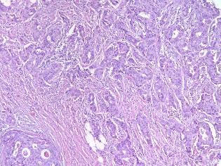 Fig. : INVASIVE DUCTAL CARCINOMA (NST) - Tumour Cells in Tubules, Ducts, and Trabeculae Having Moderate Cytoplasm Hyperchromatic Nuclei Prominent Nucleoli Surrounded by a Dense Desmoplastic Stroma.