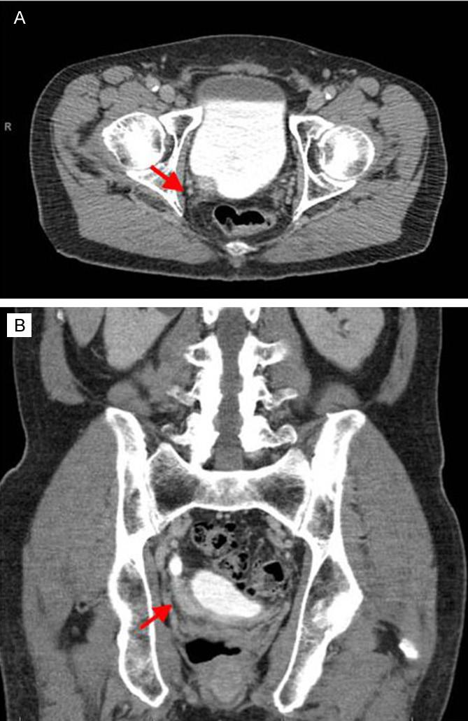 Results Figure 1. CT findings of a ureter amyloidosis (case 9). There is an approximately 1.