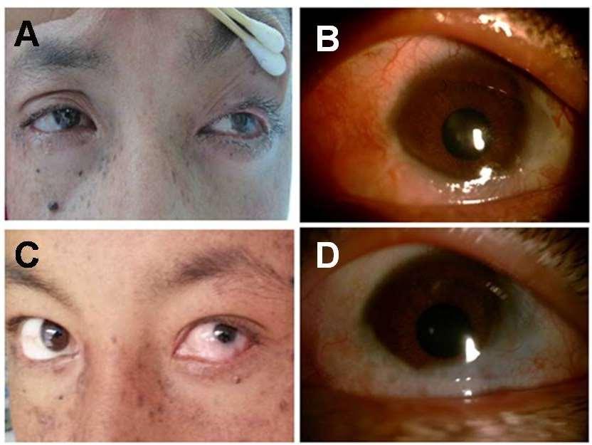 Recurrent Conjunctival Squamous Cell Carcinoma Fig. 2 : (A) General photograph of eyes at 2 weeks after tumor excision.
