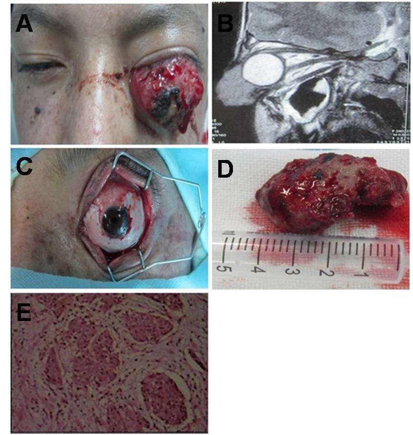 Zhao et al Fig. 1 : (A) General photograph of the conjunctival tumor. (B) Conjunctival tumor observed by MRI.