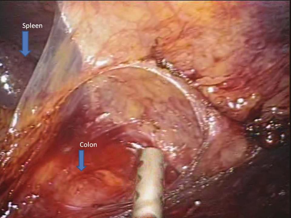 Minimally Invasive Surgery 3 (a) (b) Figure 2: Splenic flexure mobilization. (a) (b) (c) (d) Figure 3: Pelvic dissection.