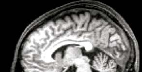 Prefrontal Cortex Reactive Involuntary Brain for