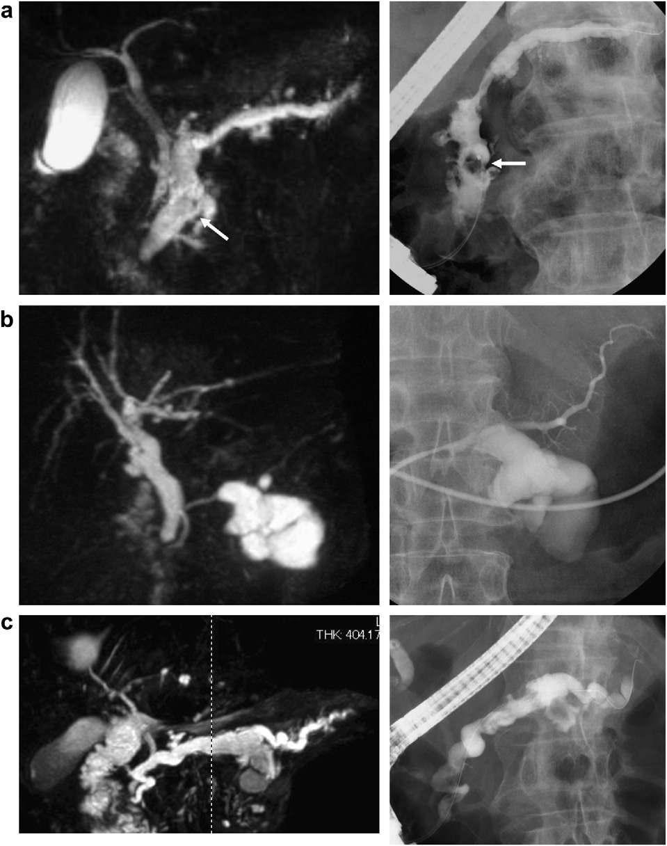 M. Tanaka et al. / Pancreatology 12 (2012) 183e197 185 Fig. 1. MRCP (left panels) and ERCP (right panels) demonstrating the three morphological types of IPMN. a. Main duct type with a mural nodule (arrows).
