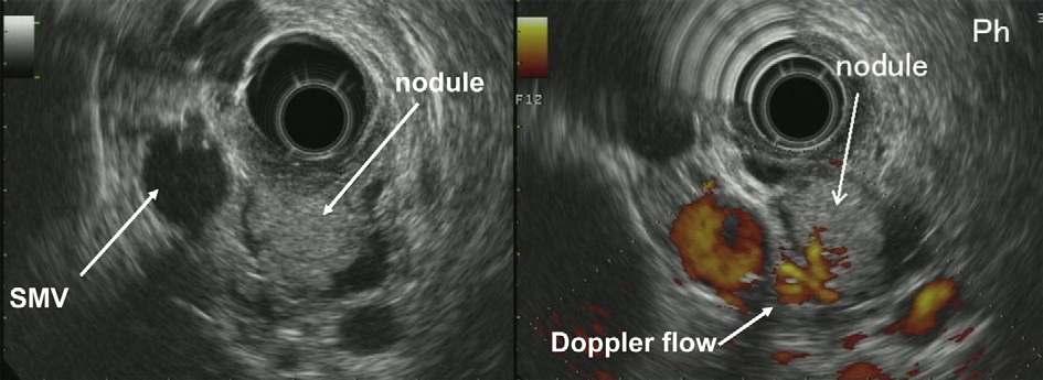 188 M. Tanaka et al. / Pancreatology 12 (2012) 183e197 Fig. 3. EUS showing a mural nodule in the dilated MPD with Doppler flow indicating the presence of a blood supply.
