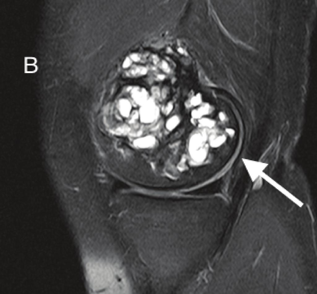 increase in size of a T1 and T2 heterogeneous multilobulated, expansive osseous lesion, as indicated by the arrows, extending from the posterior distal medial femoral metaphysis to the medial femoral