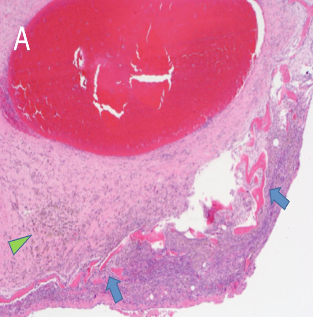 hypointense and T2 heterogeneous subcortical intraosseous metaphyseal lesion.