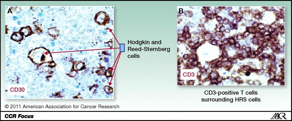 A, Hodgkin lymphoma stained for CD30. Katz J et al.