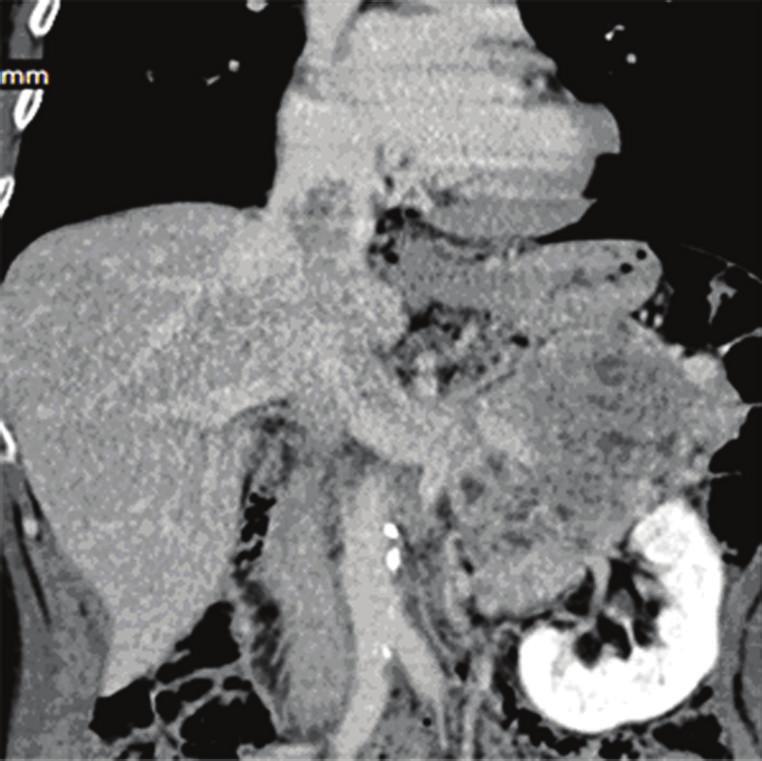 2 Case Reports in Urology (a) (b) Figure 1: MSCT images of supradiaphragmatic IVC tumor thrombus ((a) frontal reconstruction and (b) axial scan at the level of intrapericardial part of IVC).