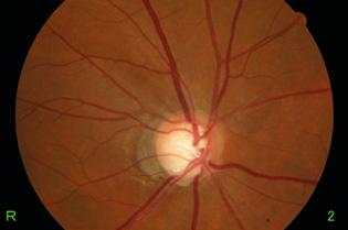 4 Chapter 3 Clinical cases 8 MODERATE GLAUCOMA (PRIMARY OPEN-ANGLE GLAUCOMA) 2-year-old female, no family history Patient diagnosed with glaucoma during medical check-up 2 mmhg/.2-4. (sph), -.