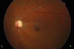 8 Chapter 3 Clinical cases 2 EARLY TO MODERATE GLAUCOMA (PRIMARY OPEN-ANGLE GLAUCOMA) 3-year-old male, no family history 2 mmhg/.2 -. (sph), -. (cyl) x Rim thinning at to 2 o clock position.