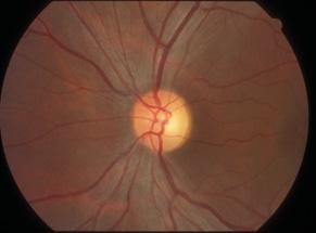 4 Chapter 3 Clinical cases LEBER HEREDITARY OPTIC NEUROPATHY (BILATERAL) 3-year-old male, no family history Patient reported decreased visual acuity in right eye Patient diagnosed with central serous