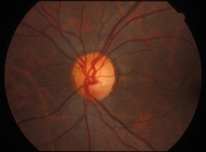 Chapter 3 Clinical cases 8 BILATERAL OPTIC NEURITIS (MULTIPLE SCLEROSIS) 2-year-old female, no family history Demo Jane, // (2yrs) Left eye (OS) / 2//3 / 4::8. 4. %..% %...82% %...% %...% 2.