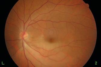 Retina Single field 2 BRANCH CENTRAL RETINAL ARTERY OCCLUSION -year-old female, no family history 4 mmhg/. 4. (sph),.