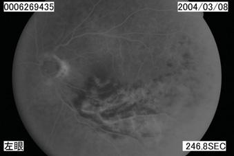 Retina Single field 3 BRANCH CENTRAL RETINAL VEIN OCCLUSION -year-old male, no family history Patient reported decreased visual acuity in left eye, blurred and double vision mmhg/.2 3. (sph), 2.