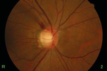 Glaucoma Single field 2 VERY EARLY STAGE GLAUCOMA (NORMAL TENSION GLAUCOMA) -year-old female, no family history Patient reported decreased visual acuity in both eyes and discomfort in left eye mmhg/.