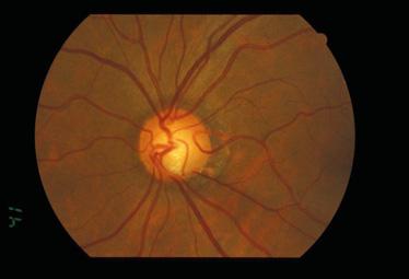 28 Chapter 3 Clinical cases 2 EARLY STAGE GLAUCOMA (NORMAL TENSION GLAUCOMA) 3-year-old female, no family history Optic nerve cupping observed during unrelated emergency eye surgery 2 mmhg/.2.2 (sph) C/D =.