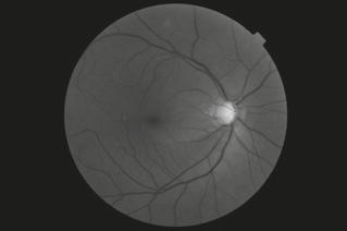 Glaucoma Single field 2 3 EARLY STAGE GLAUCOMA (PRIMARY OPEN-ANGLE GLAUCOMA) OCT -year-old female, her brother has POAG Patient visited clinic to rule out glaucoma because of her family history mmhg
