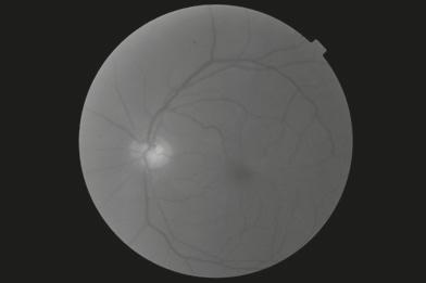 Chapter 3 Clinical cases 4 EARLY STAGE GLAUCOMA (WITH CATARACT) OCT -year-old male, no family history Patient reported defective vision in both eyes over the last months and glare at night while