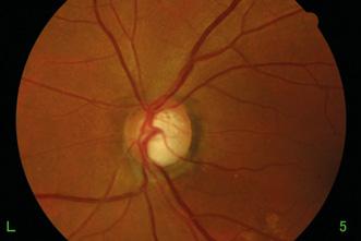 Glaucoma Single field EARLY STAGE GLAUCOMA (NORMAL TENSION GLAUCOMA) 8-year-old female, father had glaucoma Optic nerve cupping detected during routine medical visit mmhg/.2 -. (sph), -.