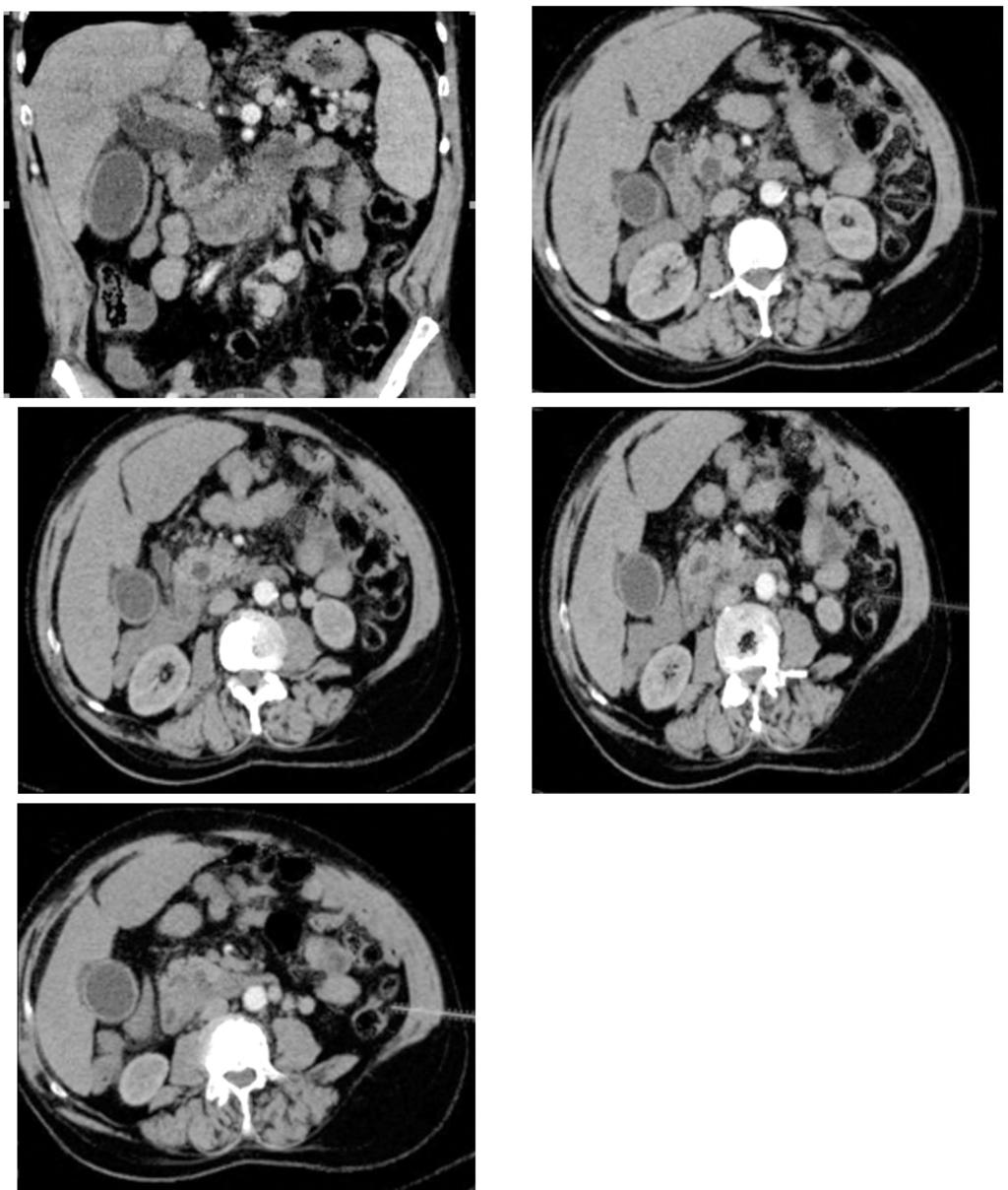 2618 Accuracy of MDCT Cholangiography in Evaluation of Causes of Biliary Tract Obstruction (A) (B) (C) Fig. (3): Male patient 73 years old presented with jaundice and epigastric pain.