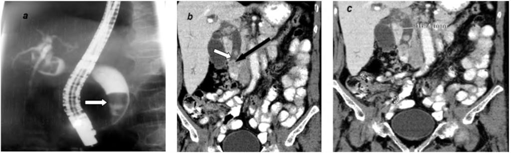 dilatation of CBD and IHBR. Crescent sign (white arrow) and central stone nidus (black arrow) was demonstrated. (A) (B) (C) (D) (E) Fig. (4): Male patient 59 years old presented with jaundice.