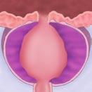 The enlarged tissue is surgically removed and the urethra is thus relieved from the pressure.