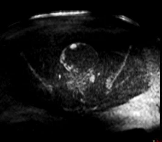 case 4 DWI Papillary projections moderate