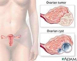 Ovarian cancer It is a leading cause of death among women It is the second most common gynecological cancer after