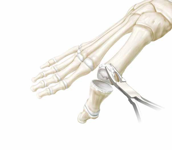 The CARTIVA implant requires a minimum of 2 mm of surrounding good bone stock.
