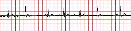 Differentiating Heart Blocks 8 There are more P waves than QRS s Is ventricular rhythm regular?