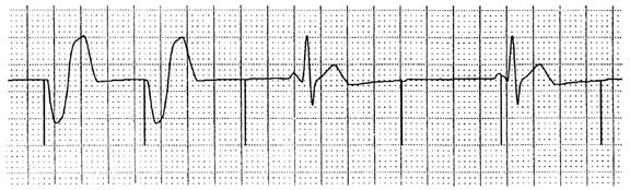 Loss of Capture Assess the patient Quality of pulse Observe for signs of improved cardiac output mental status,