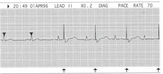 Sensing is the ability of the demand pacemaker to identify electrical activity which stems from the myocardium Undersensing occurs when the pacemaker does not sense intrinsic activity, and delivers a