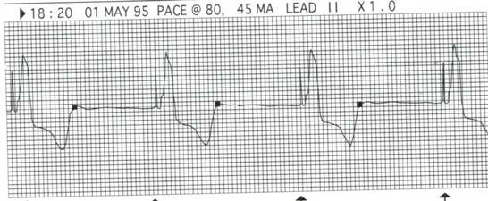 Oversensing is inappropriate inhibition of a demand pacemaker due to detection of signals other than R waves, such as muscle artifact or T waves When oversensing occurs the pacemaker will not