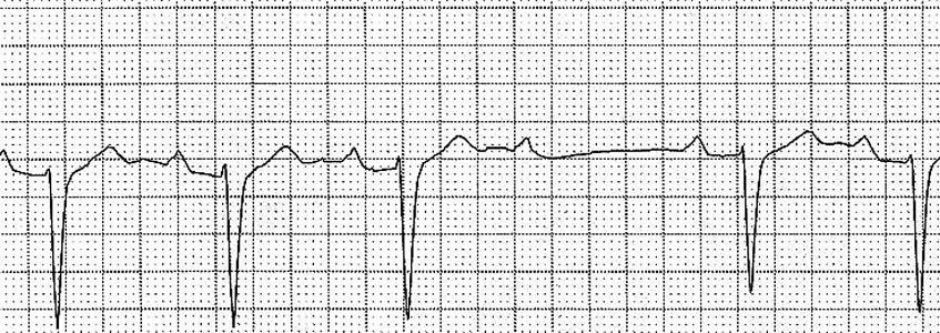 The typical patient who benefits from noninvasive pacing is one with a primary conduction disturbance or transient disorder such as a post-cardioversion bradycardia or bradycardia