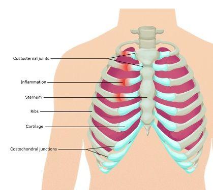 Musculoskeletal (costochondritis, precordial catch) Days, months, or years of chest pain Seconds to several minutes Generally