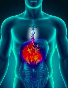 Gastroesophageal reflux Abdominal pain Heartburn symptoms