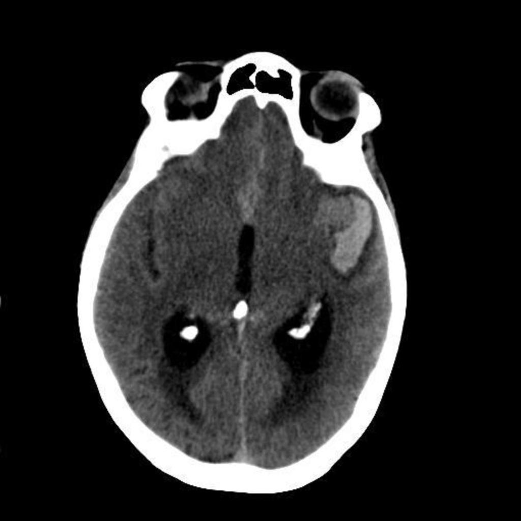 Fig. 5: Unenhanced CT scan of the head showing acute hydrocephalus, subarachnoid haemorrhage within the interhemispheric fissure, a predominantly