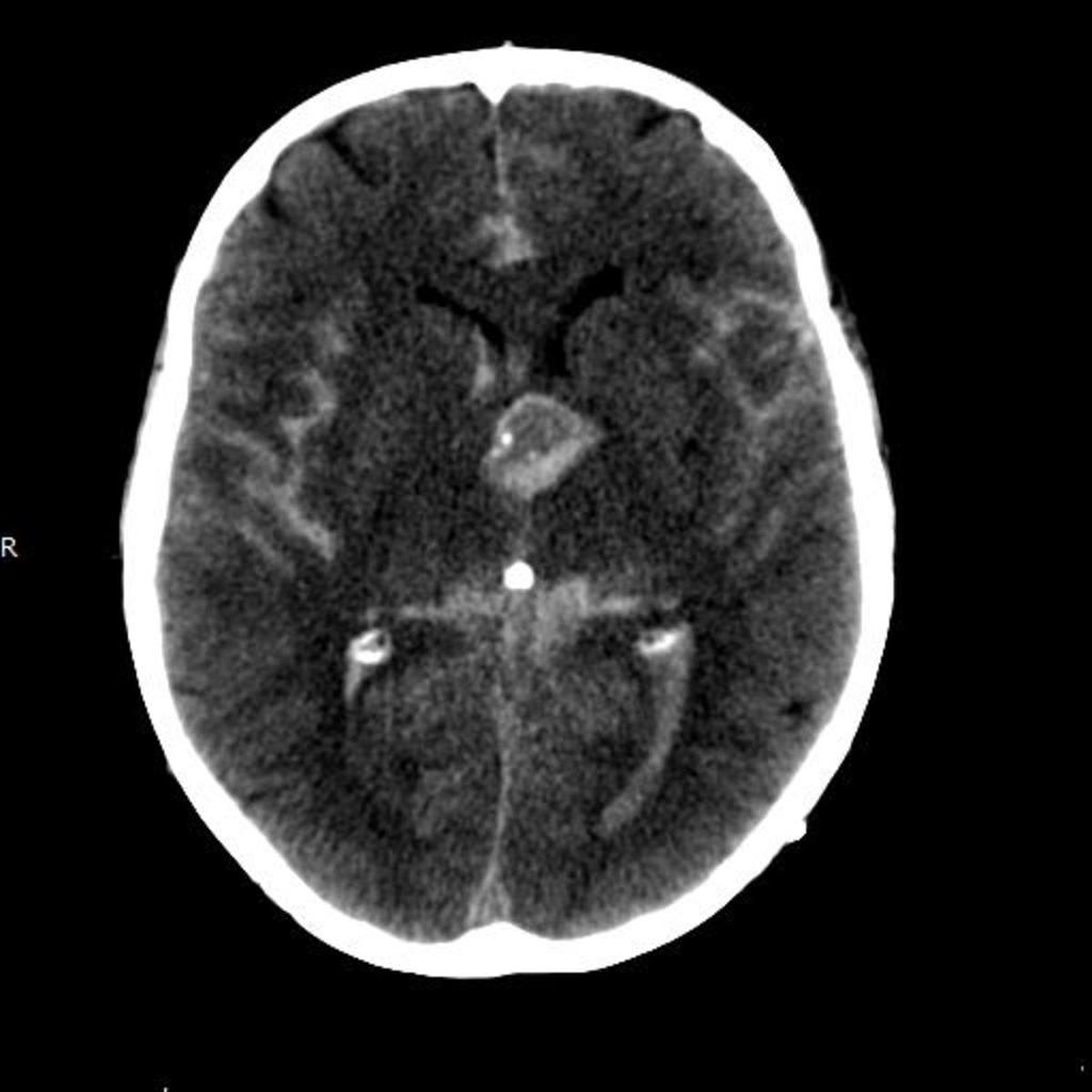 Fig. 1: Unenhanced CT scan of the head showing extensive subarachnoid haemmorhage and intraventricular haemorrhage with a "filling