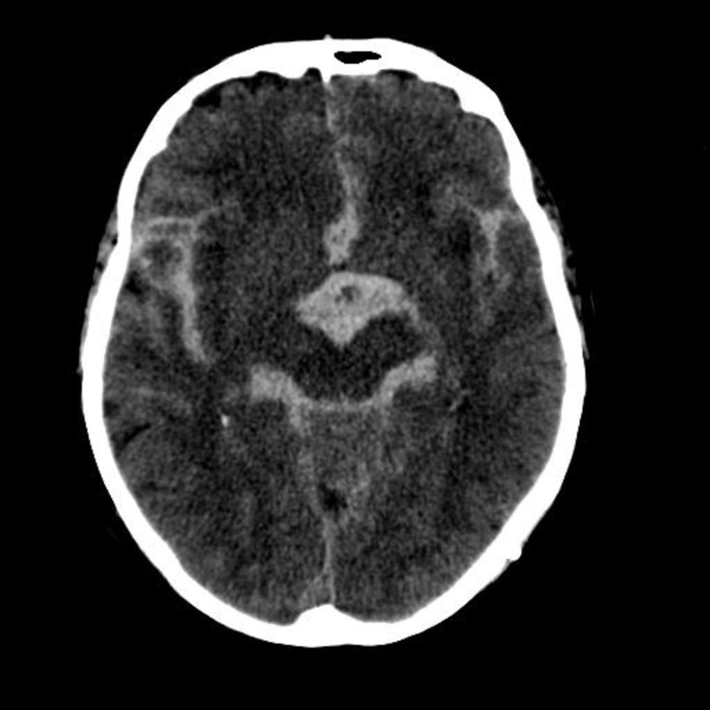 Fig. 1: Unenhanced CT scan of the head showing acute blood with the interpeduncular, quadrigeminal and ambient