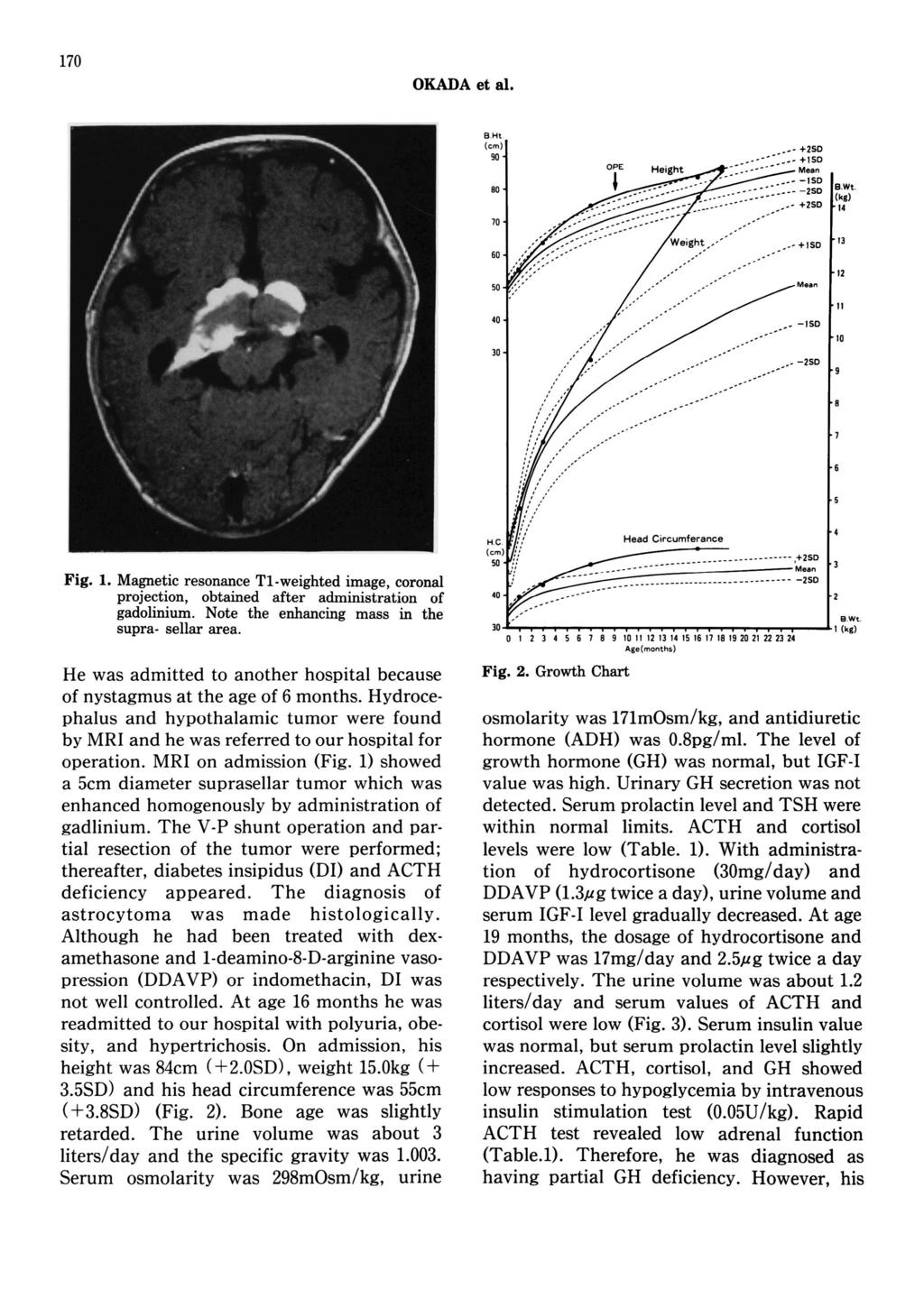170 OKADA et al. Fig. 1. Magnetic resonance T1-weighted image, coronal projection, obtained after administration of gadolinium. Note the enhancing mass in the supra- sellar area.